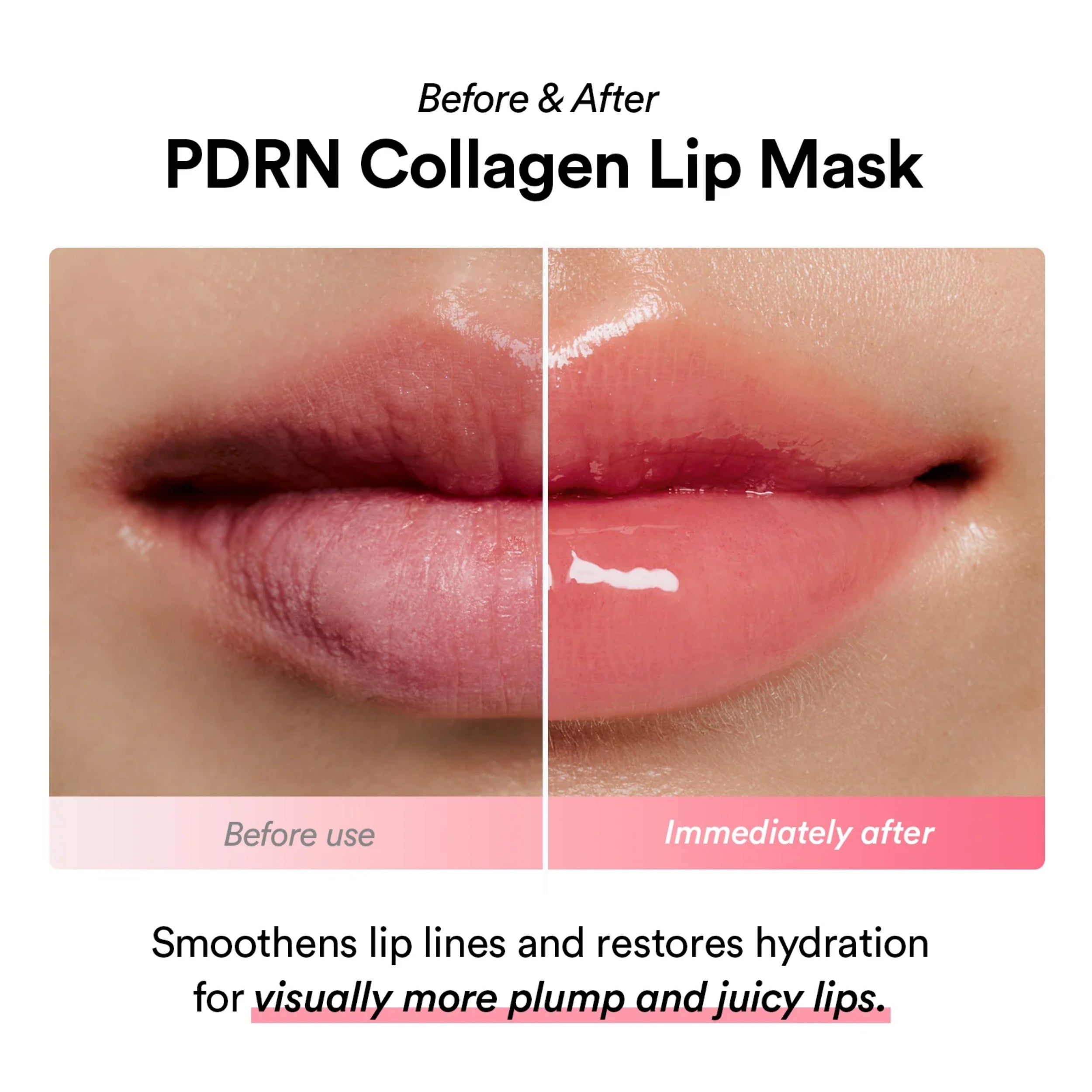 Before and after effect of PDRN Collagen Lip Mask on lips